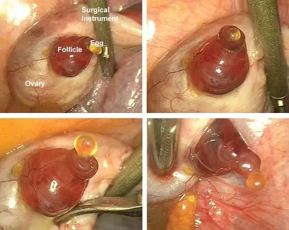 eggfolicle